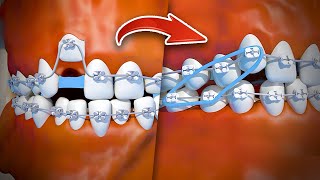 How braces are put on  Step by step [upl. by Htez656]