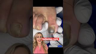 Doctor reacts toenail removal [upl. by Lezlie221]