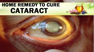 मोतियाबिंद का शर्तिया इलाज करेंगे ये चमत्कारी घरेलू नुस्खे  HOME REMEDY TO CURE CATARACT [upl. by Centeno]