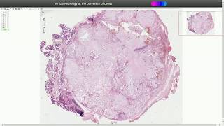 Pleomorphic Adenoma  Histopathology [upl. by Esinehs585]