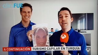 Trasplante de pelo en Turquía Antena 3 NOTICIAS cliniFUE [upl. by Lucchesi]