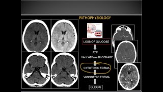 Approach to Ischemic Stroke on CT Neuroimaging Made Easy [upl. by Gnuy]