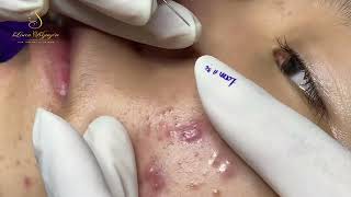 Loan Nguyen Acne Treatment 15633 [upl. by Line]