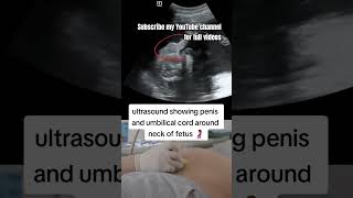 Ultrasound showing penis and umbilical cord around neck of Fetusbaby [upl. by Rimaj]