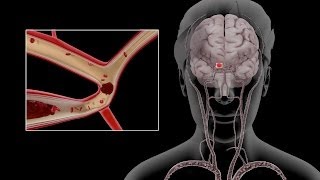 Carotid Dissection [upl. by Abramo]