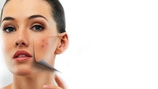 How To Treat Acne Scars  Expert Advice  Post Acne Skin Care  Glamrs [upl. by Nywnorb339]