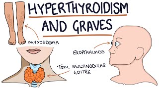 Understanding Hyperthyroidism and Graves Disease [upl. by Ahsertal]