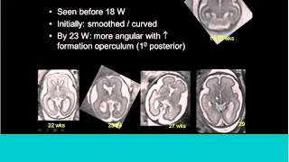 Topics in Fetal Medicine  Gilbert Vezina MD FACR [upl. by Nairbal]