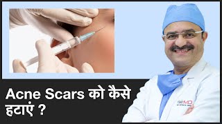 Acne Scars को कैसे हटाएं How To Remove Acne Scars  ClearSkin Pune  In HINDI [upl. by Nnayd]