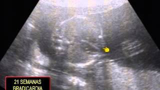 BRADICARDIA FETAL SOSTENIDA [upl. by Benedic]