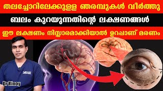 തലച്ചോറിലേക്കുള്ള ഞരമ്പുകൾ വീർത്തു ബലം കുറയുന്നതിന്റെ ലക്ഷണങ്ങൾ ഈ ലക്ഷണം നിസ്സാരമാക്കിയാൽ Dr Rinoy [upl. by Bristow]