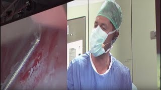 Live Surgery  Bladder Tumour Resection [upl. by Ahsikit]