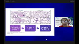 Hipertensión pulmonar actualización [upl. by Esilegna]