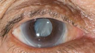 New eye drops may help treat cataracts [upl. by Naerol]