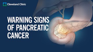 6 Warning Signs of Pancreatic Cancer [upl. by Ahcurb]