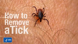 How to remove a tick [upl. by Eldon]