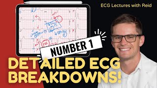 Improve your EKG Skills test yourself  ECG No 1 [upl. by Waligore132]