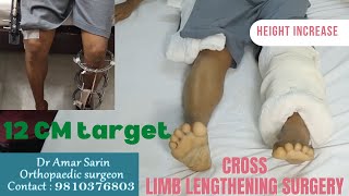 Height Increase Surgery  Target 12 Cm  Cross Limb Lengthening  Dr Amar Sarin [upl. by Oicirbaf97]