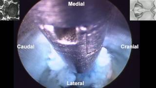 Percutaneous Endoscopic Interlaminar Lumbar Discectomy PEILD by Dr Hyeun Sung Kim01 [upl. by Shayn]