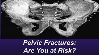 Pelvic Fractures EXPLAINED Causes Types amp Fast Recovery Tips [upl. by Tteirrah]