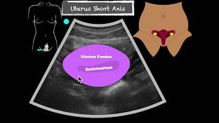 POCUS Female Pelvis Transabdominal scanning sequence [upl. by Erinn]