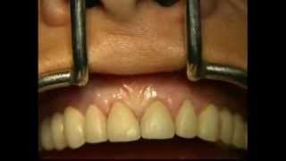 Gingival Surgery  Internal Bevel [upl. by Airalav]