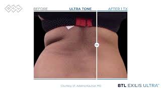 BTL Exilis Ultra VIDEO Waiting room [upl. by Liza]