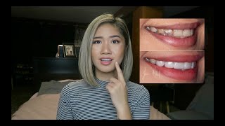 FINALLY GOT PORCELAIN VENEERS amp 6 MONTHS UPDATEREVIEW  PART 3  itzalyssaaa [upl. by Allicerp]