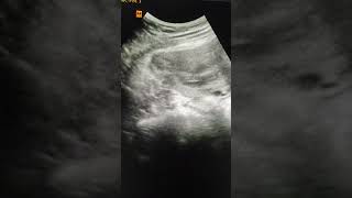 Bicornuate uterus and pregnancy [upl. by Natalie]