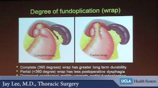 Surgery and the Esophagus  What does minimally invasive mean  Dr Jay Moon Le [upl. by Cindelyn]