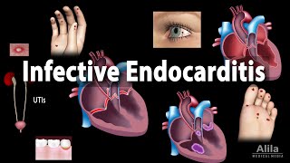 Infective Endocarditis Animation [upl. by Anatsirhc699]