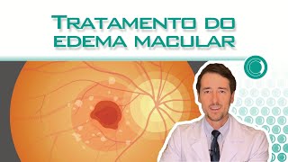 Tratamento do edema macular [upl. by Aneelas]