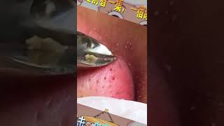 Blackhead Removal Acne Removal Treatment 030 [upl. by Otsirave]