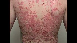 Guttate Psoriasis  What is Psoriasis amp How To Treat It [upl. by Tnairb773]