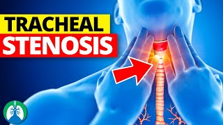 Tracheal Stenosis Medical Definition  Quick Explainer Video [upl. by Lorry]