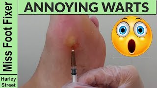 Little Wart or Verruca Acupuncture Dry needling by Miss Foot Fixer Marion Yau [upl. by Esmerelda]