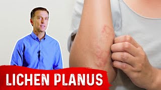 Lichen Planus Best Remedy [upl. by Dadivitan716]