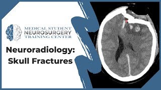 Neuroradiology Skull Fractures [upl. by Myrt]