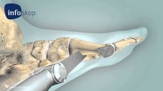 3D medical animation  Osteotomy  Hallux Valgus  designidentity [upl. by Felicidad435]