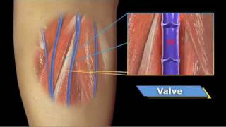 VenaCure EVLT Patient Video [upl. by Kirtap]