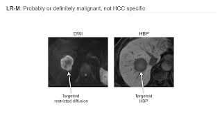 Imaging HCC and LIRADS [upl. by Ennahtur]