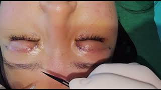 Mithup eyelid surgery lang satpa suture removal [upl. by Datnow]