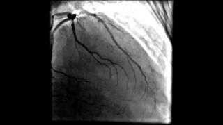 Heart angiogram coronary and three vessel disease [upl. by Leann194]