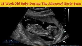 15 Week Old Baby During The Advanced Early Scan  15 Weeks Pregnant Ultrasound [upl. by Deeraf436]