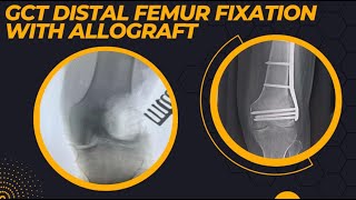 DISTAL FEMUR GCT WITH PATHOLOGICAL FRACTURE PLATING WITH ALLOGRAFT USED WITH EXCELLENT RESULT [upl. by Funk]