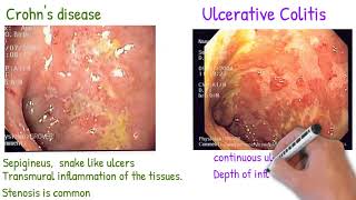 Crohns disease vs Ulcerative Colitis made simply [upl. by Doralia]