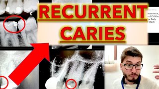 Recurrent CARIES for BEGINNERS Decay on Dental XRay Cavity teeth Removal ICDAS Radiographs [upl. by Dulsea]