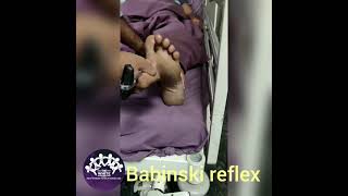 DEMONSTRATION OF BABINSKI REFLEX AND ITS VARIANTS [upl. by Salena]