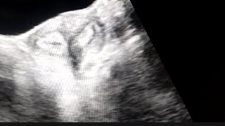 Bicornuate uterus on Ultrasound [upl. by Erminna]