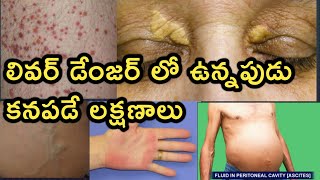 Symptoms of Liver Disease in Telugu  కాలేయ వ్యాధి లక్షణాలు [upl. by Ayna]